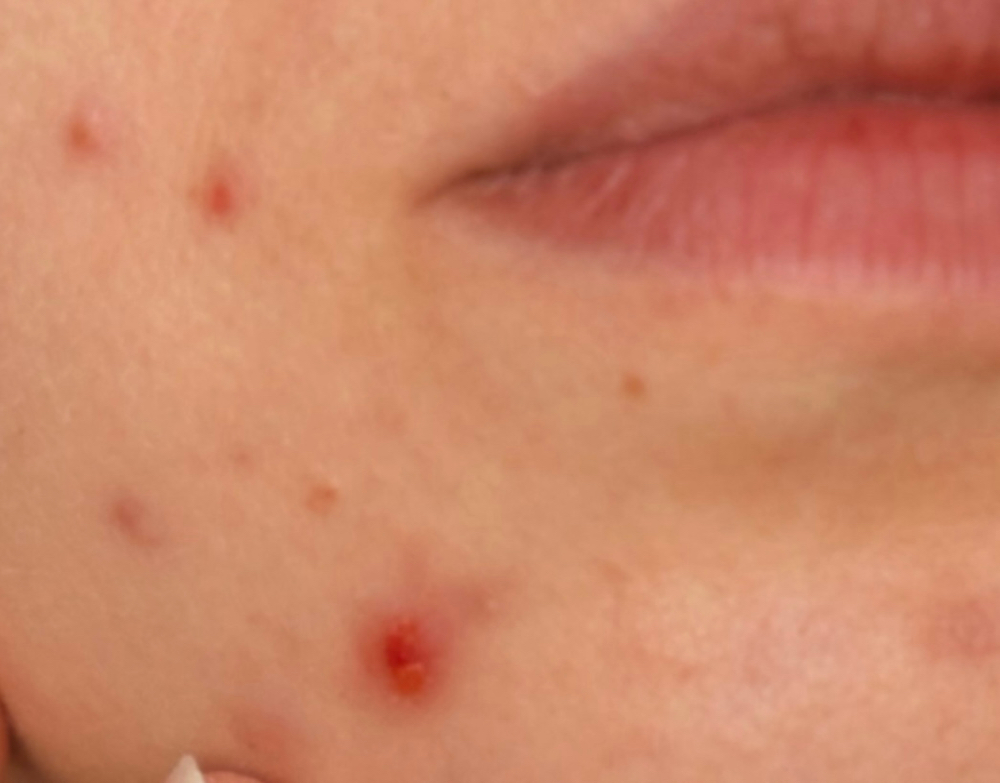 TEEN FACIAL BUNDLE & SAVE