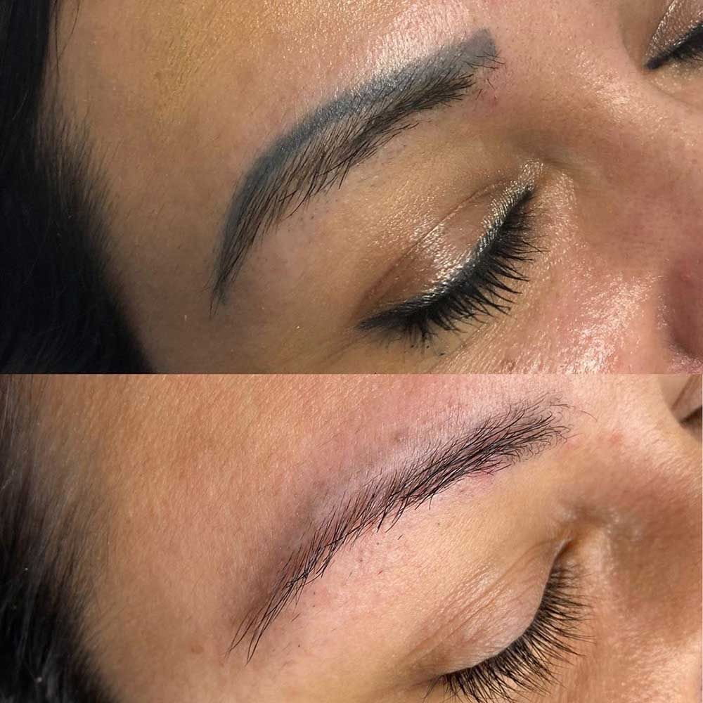 Tattoo Removal