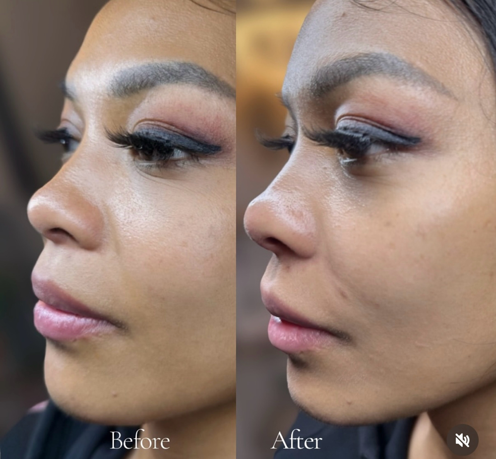 Tox - Nose Lift