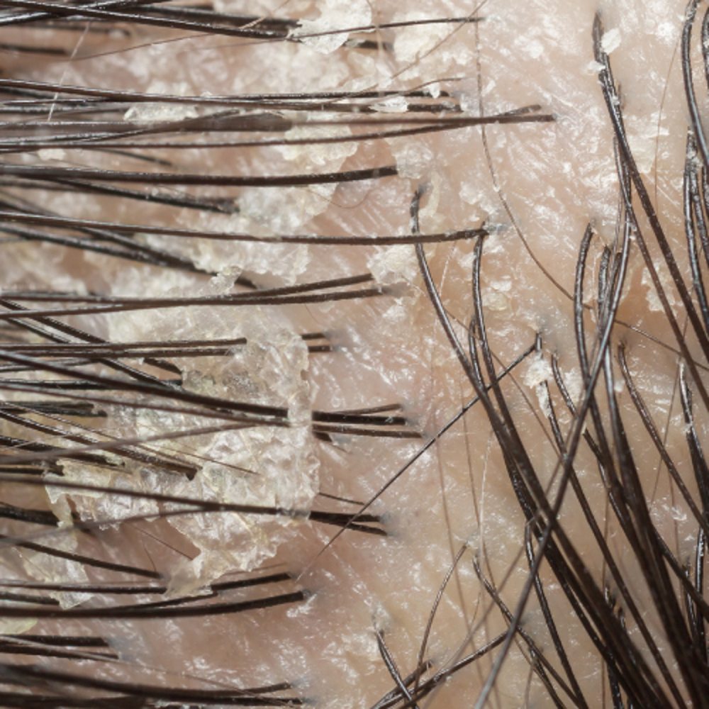 Exfoliating Detox Scalp Therapy at SLS HAIR & SCALP WELLNESS in Brooklyn, NY