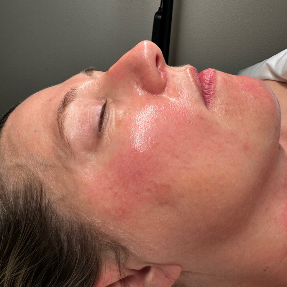 SWiCH Facial