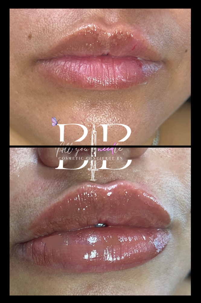 Lip Filler at AllyouneedlexBB in Grand Praire, TX
