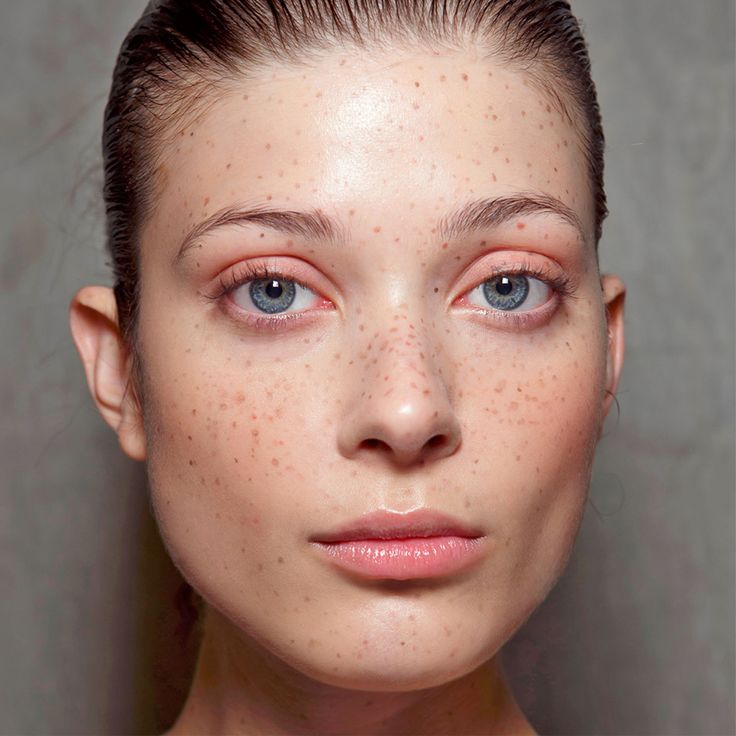 Full Face Freckles