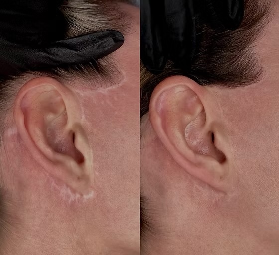 Scar Camouflage