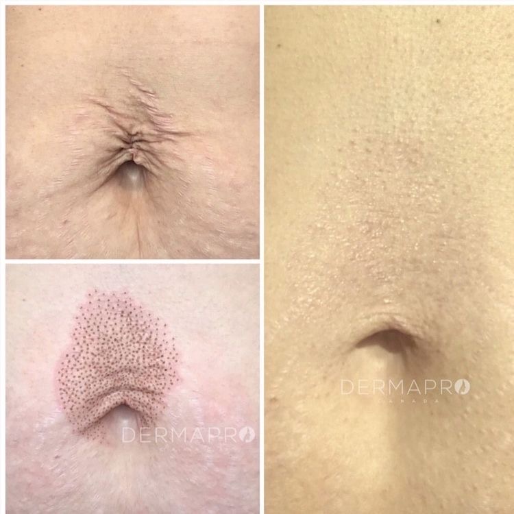 Belly Button Tightening treatment