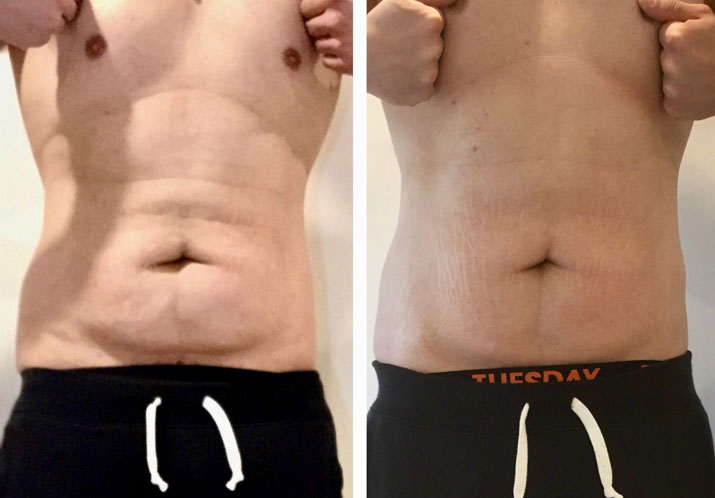 RF Skin Tightening (3 TX, 1 Area)