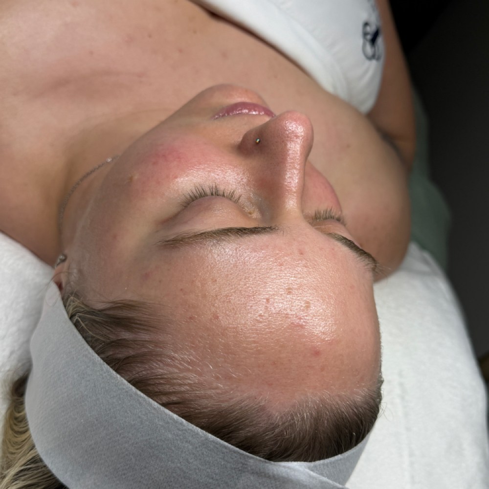 Acne & Rosacea Custom Treatment at SkyeBeauties in Bakersfield, CA