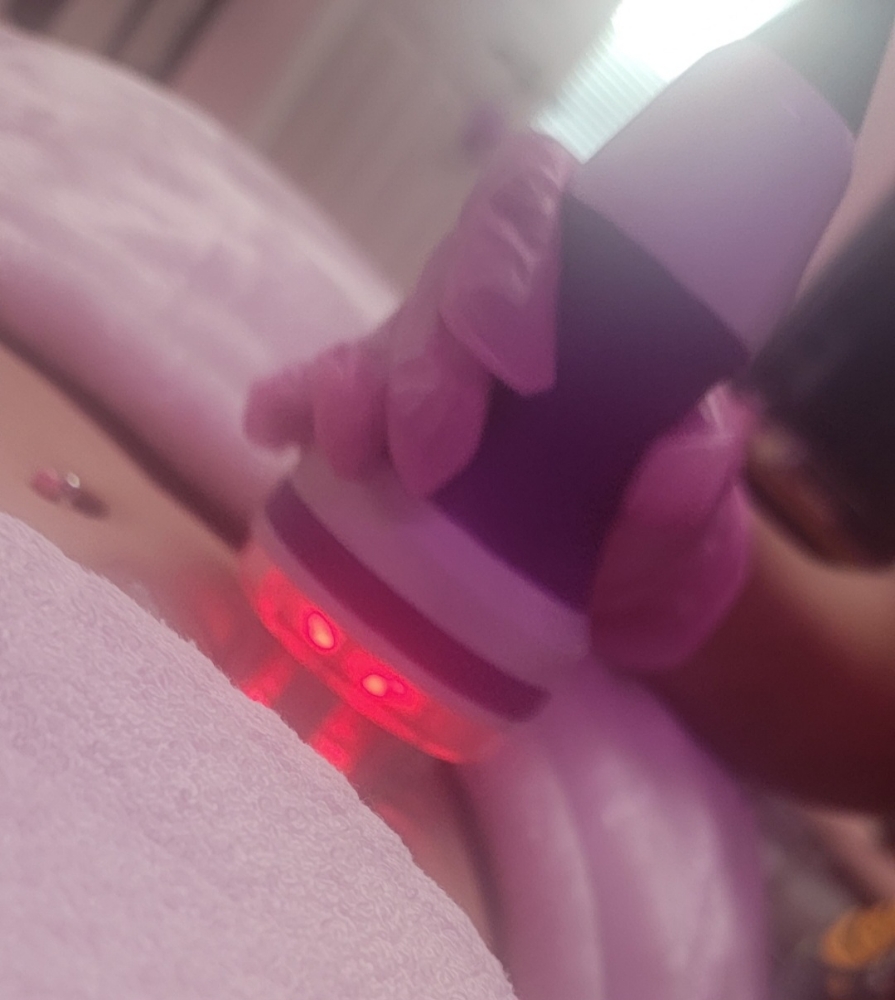 Radiofrequency Skin Tightening