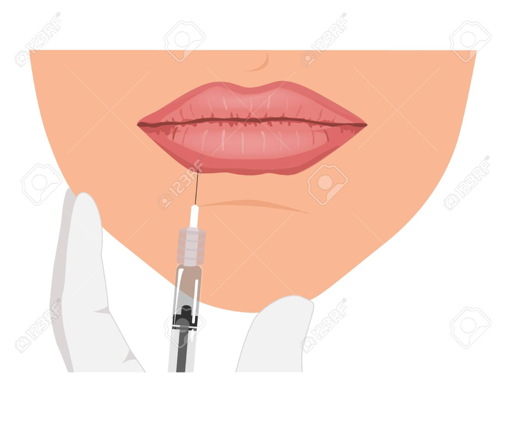 Dermal Fillers at ELM Aesthetics and Wellness in San Antonio, TX