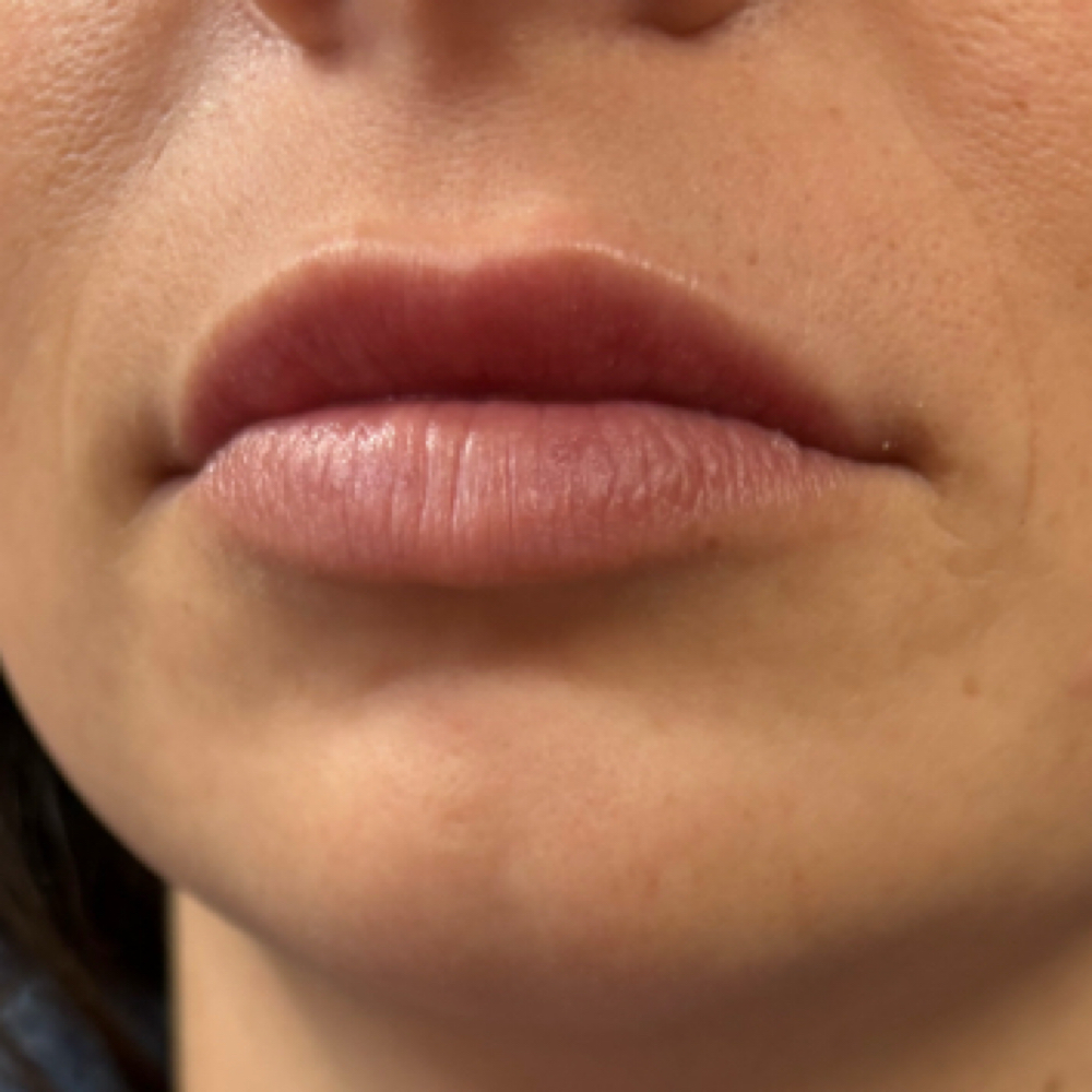 Mini Lip Filler 1/2 Syringe at The Beautyful Secret in La., LA