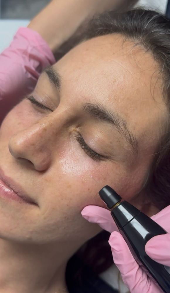 Plasma Fibroblasting