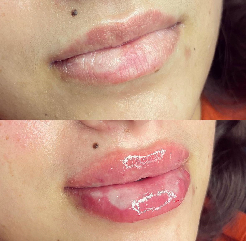 Lip Filler 1.5ML