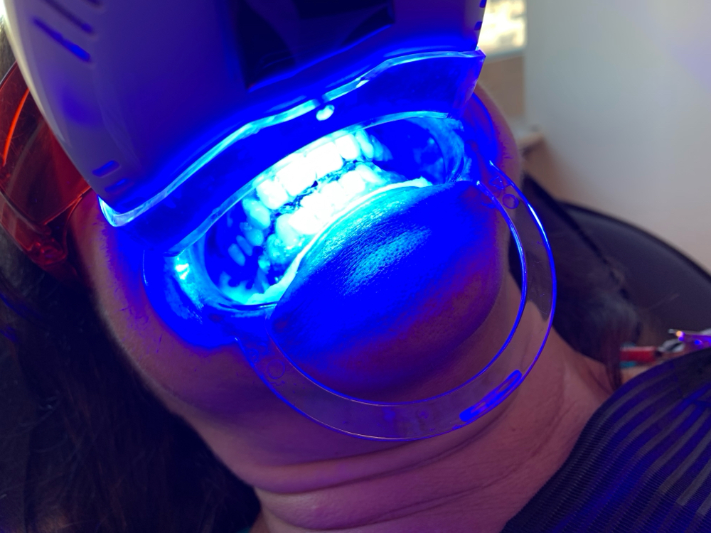 Classic Bright 💫 at Whitening Bliss✨🦷✨ in San Jose, CA