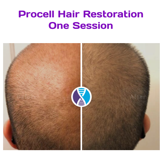 Procell Microchanneling Hair Treatm