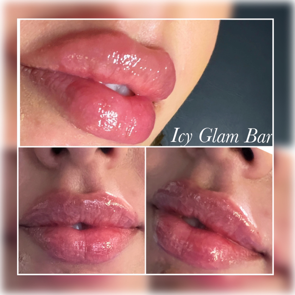 Lip Filler