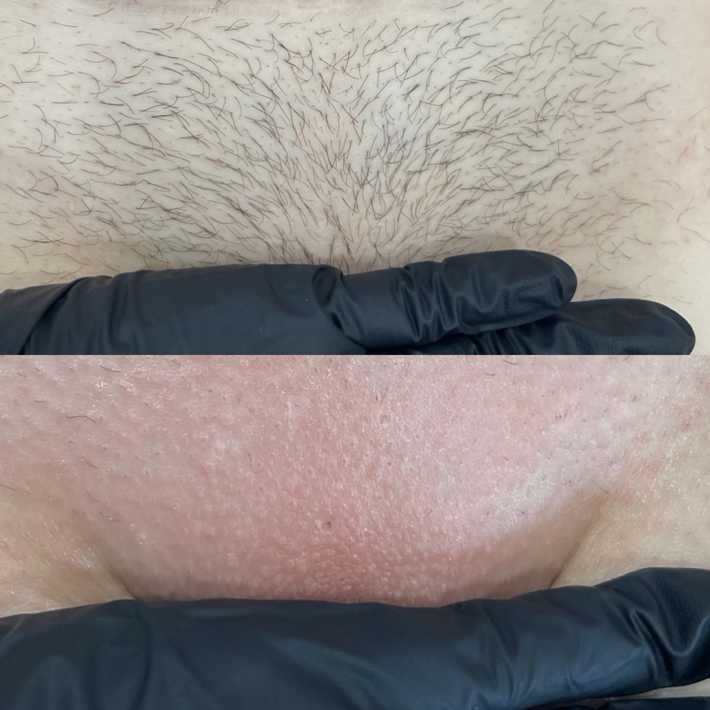 Brazilian Wax at Radiance Aesthetics by Aracely in Bakersfield, CA