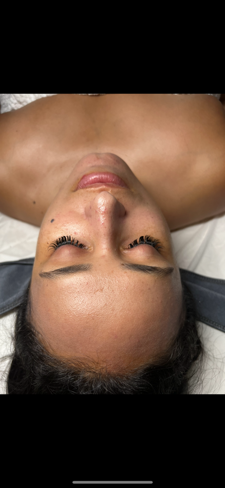 Microdermabrasion