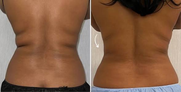 Coolsculpting