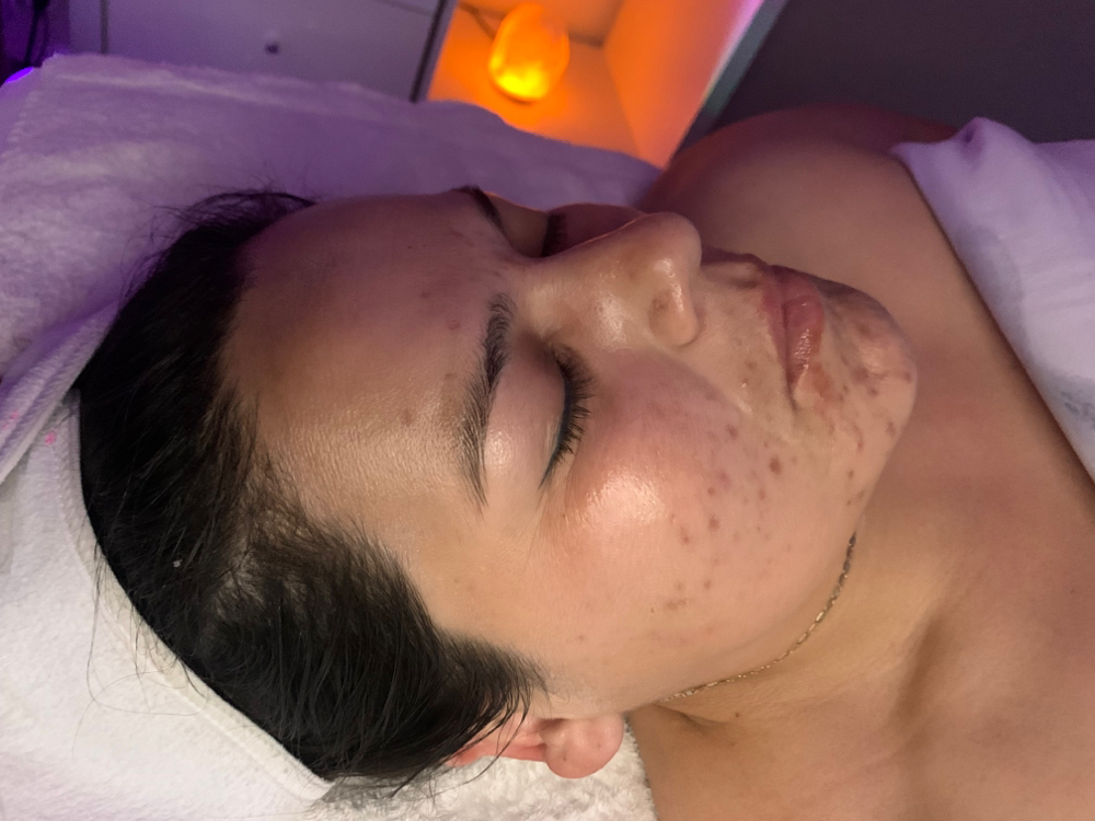 Acne Bootcamp Consult + Treatment