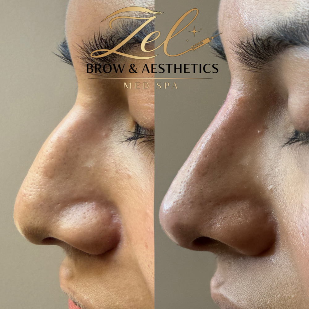 Rhino Filler at Zel Brow & Aesthetics Med Spa in Thornthon, CO