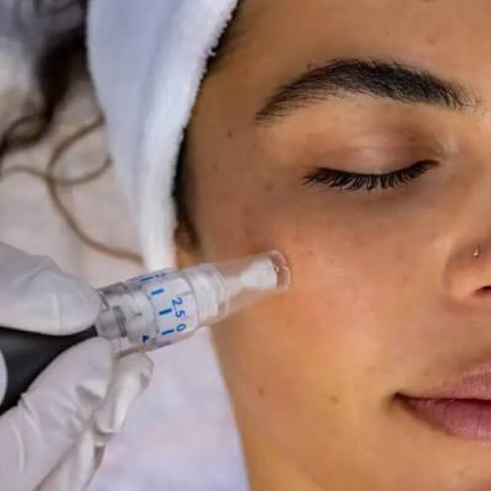 Microneedling Facial at The It Girl Glow in Staten Island, NY