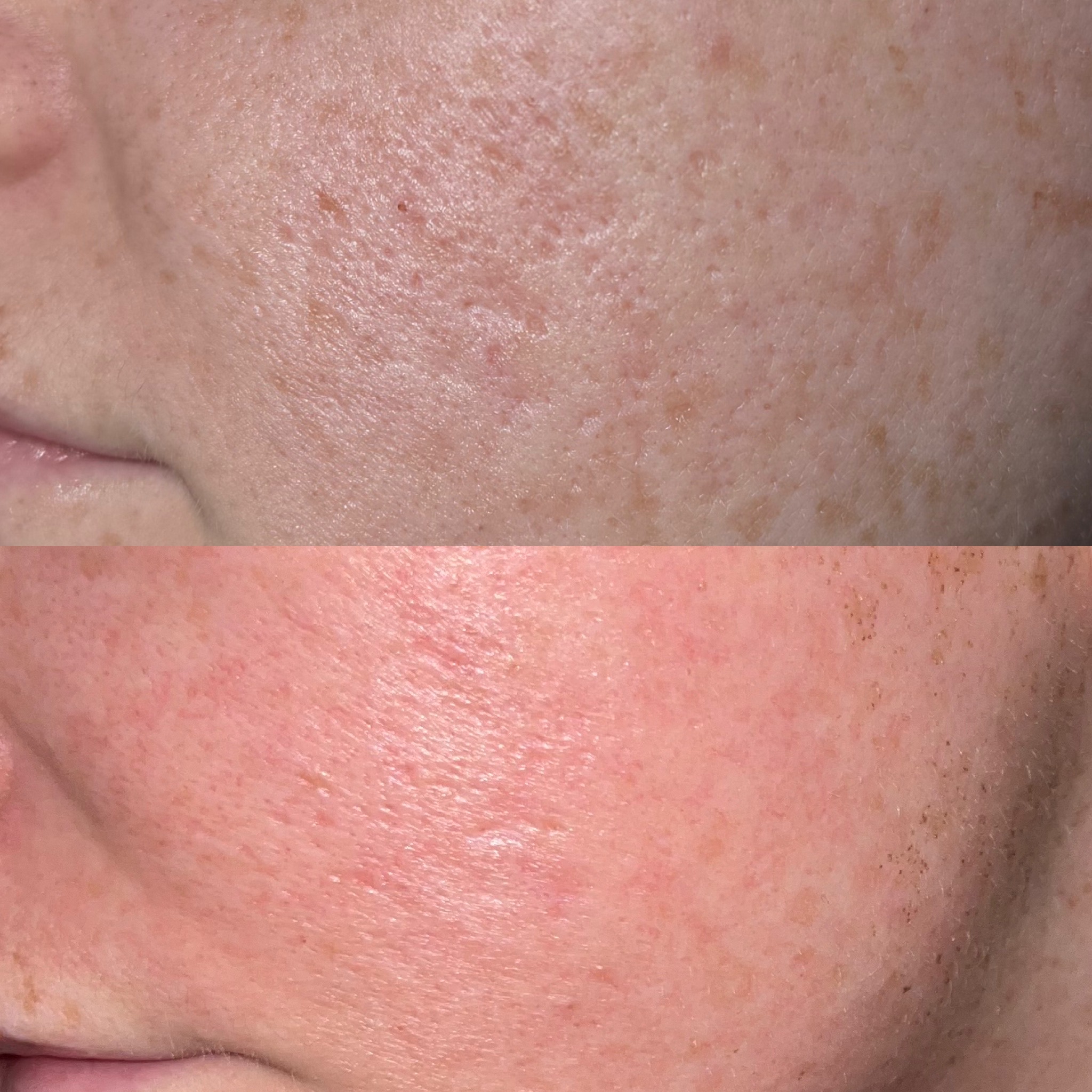 DEKA Skin Resurfacing MODERATE