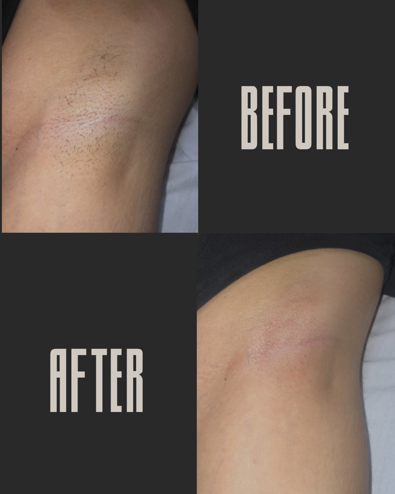 Underarm Waxing