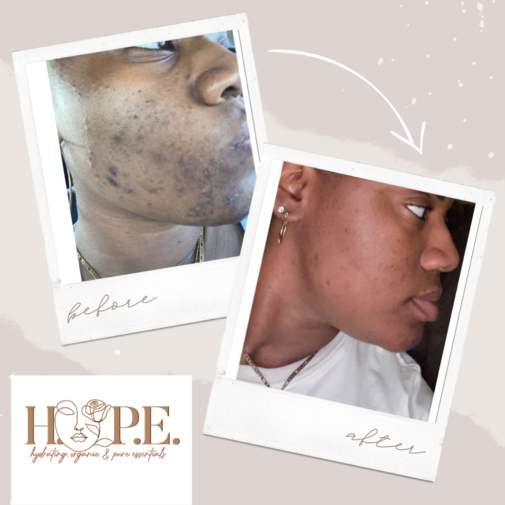 3 Chemical Peel Facial Bundle with Icy Globes(Includes Starter Kit)