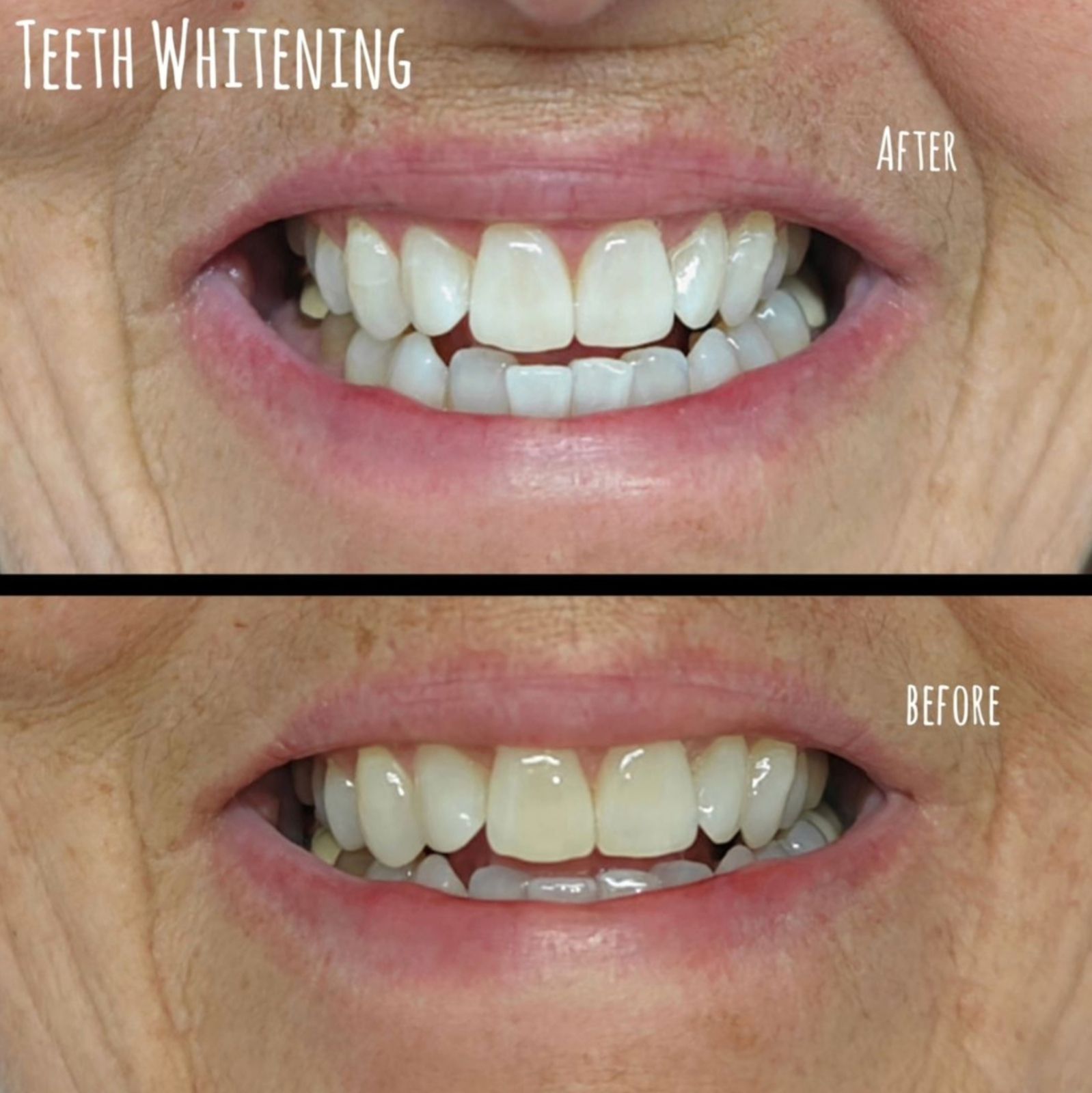 Teeth Whitening
