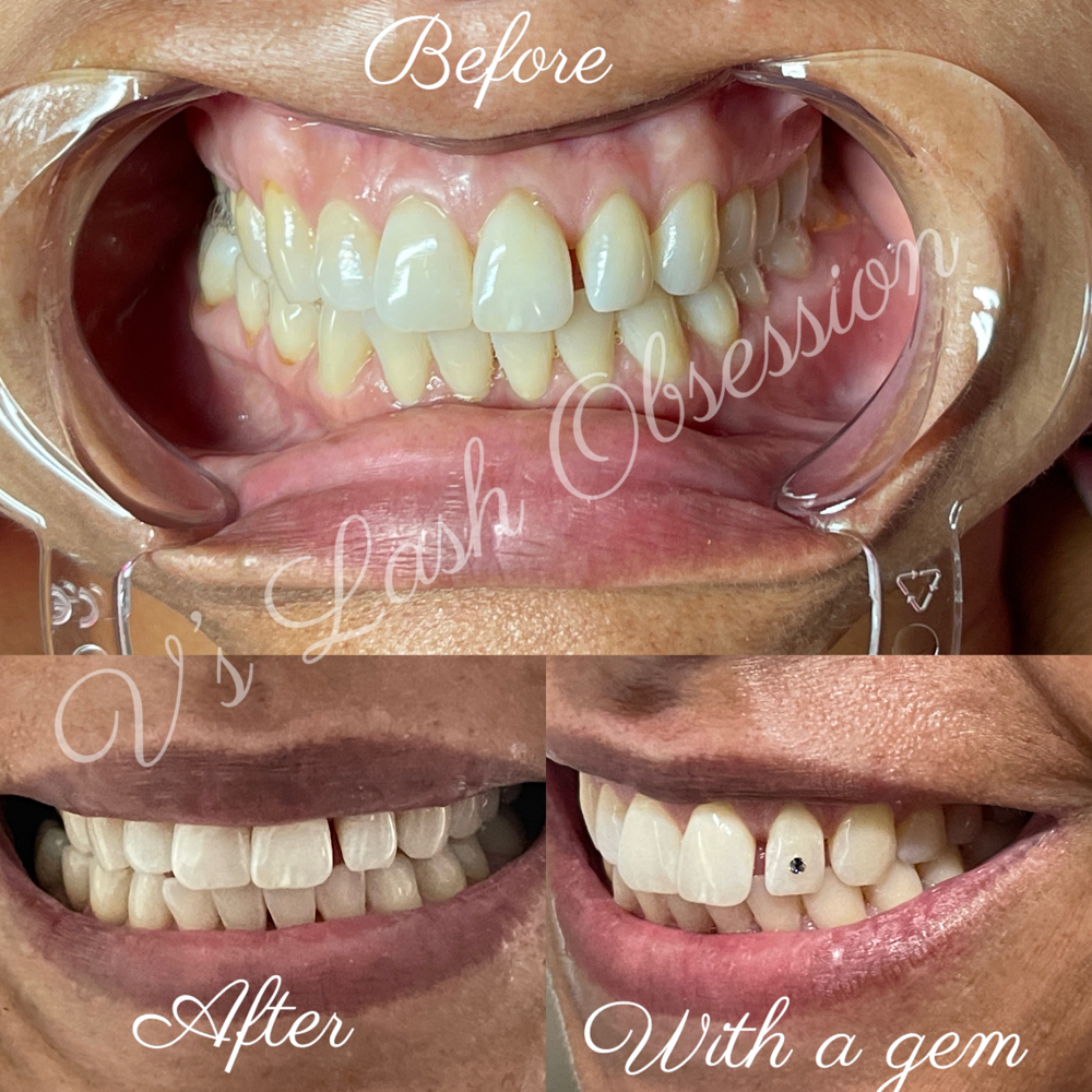 Teeth Whitening Light
