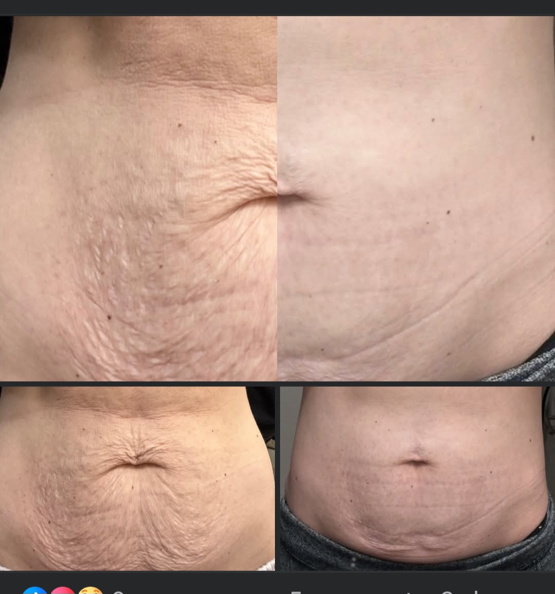 Fibroblast-Skin Tightening at Ink'd Souls Studio in Jacksboro, TX