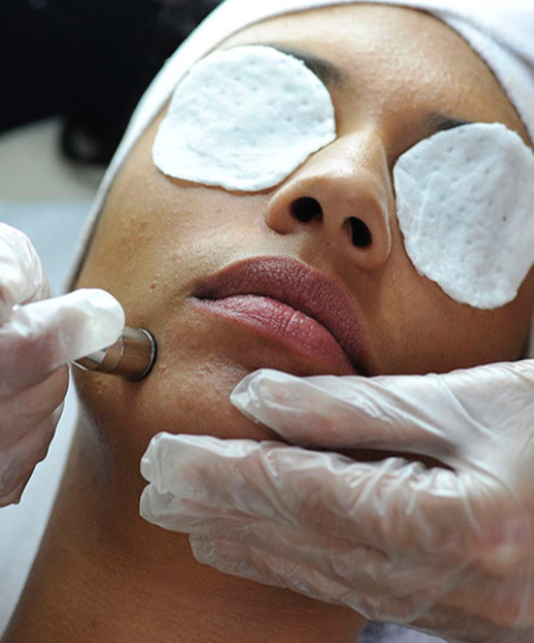 Microdermabrasion Facial