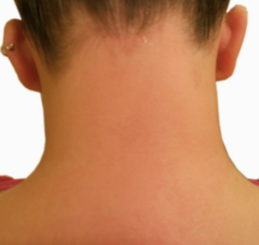 Sugaring Nape