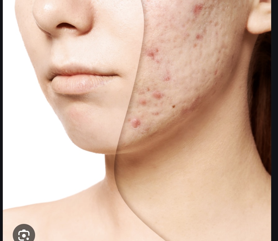 Acne Facial