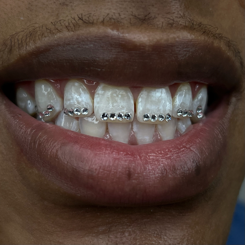 Mock Brace Line (4-6 Teeth)