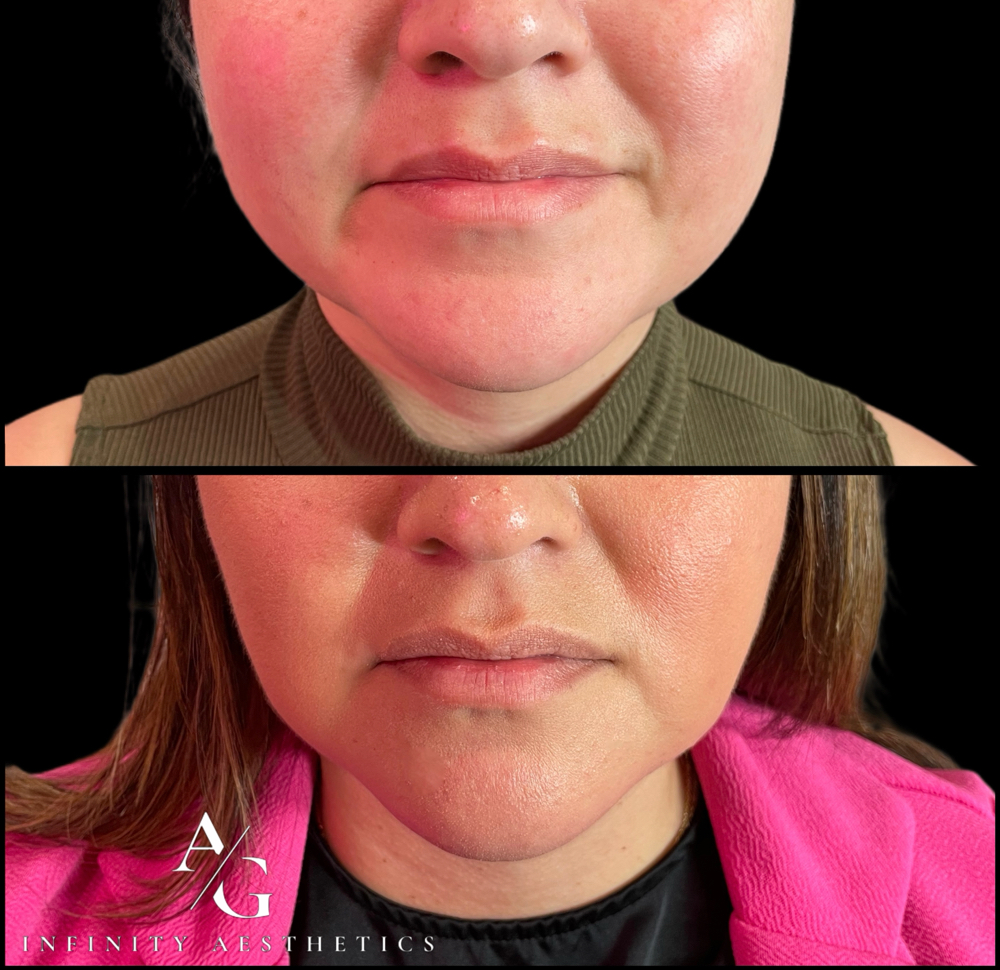 Masseter Botox (Jaw Slimming)
