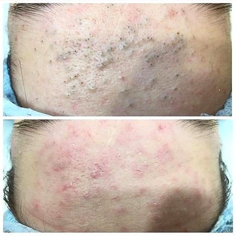 Extractions Add-On at Yulee Mac Aesthetics in Tontitown, AR