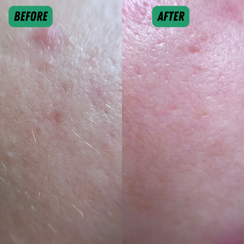 Acne Facial