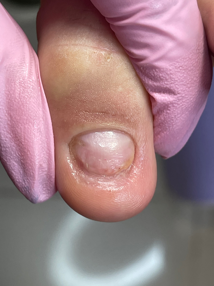 Primer Tratamiento Ibx Con Uñero