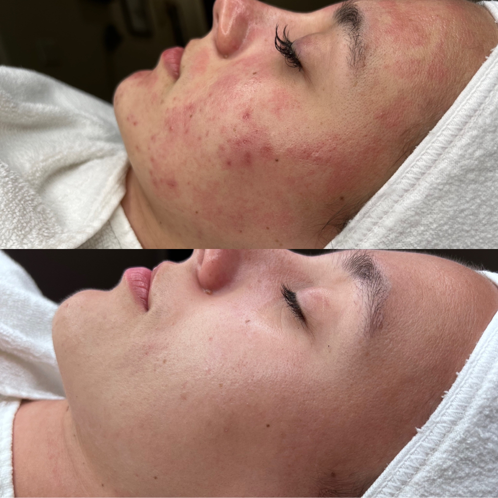 Micro-Needling