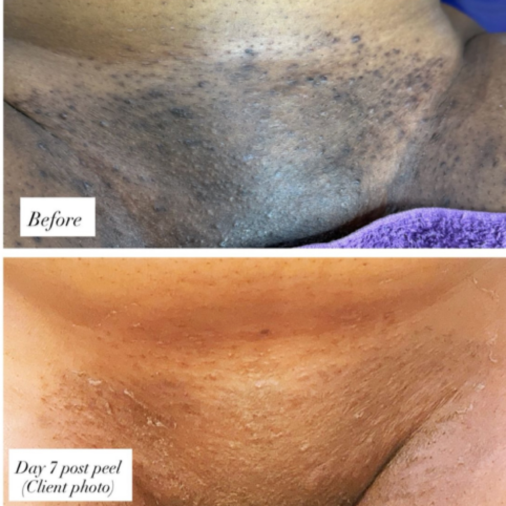 Full Bikini at Golden Bliss Aesthetics in Nanuet, NY