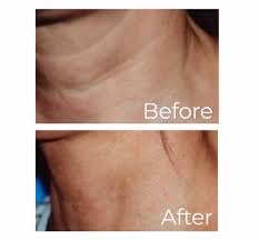 Dermal Fillers-Neck