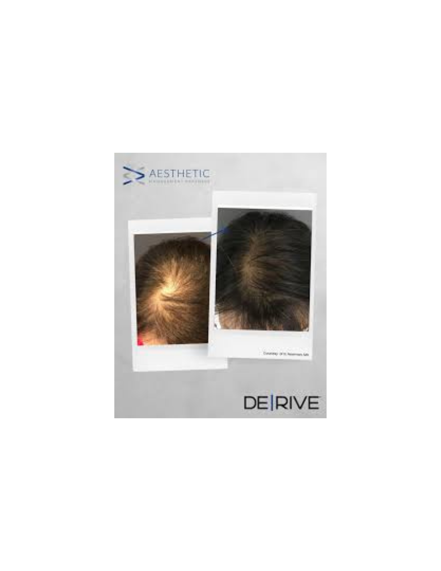 Hair Restoration