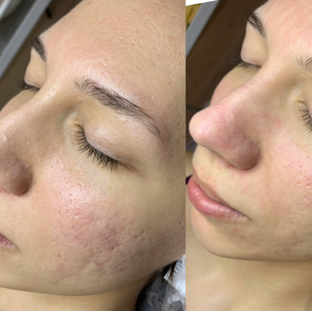 Teen Clear Skin Reset at Healthy skin by Alvina in Deerfield, IL