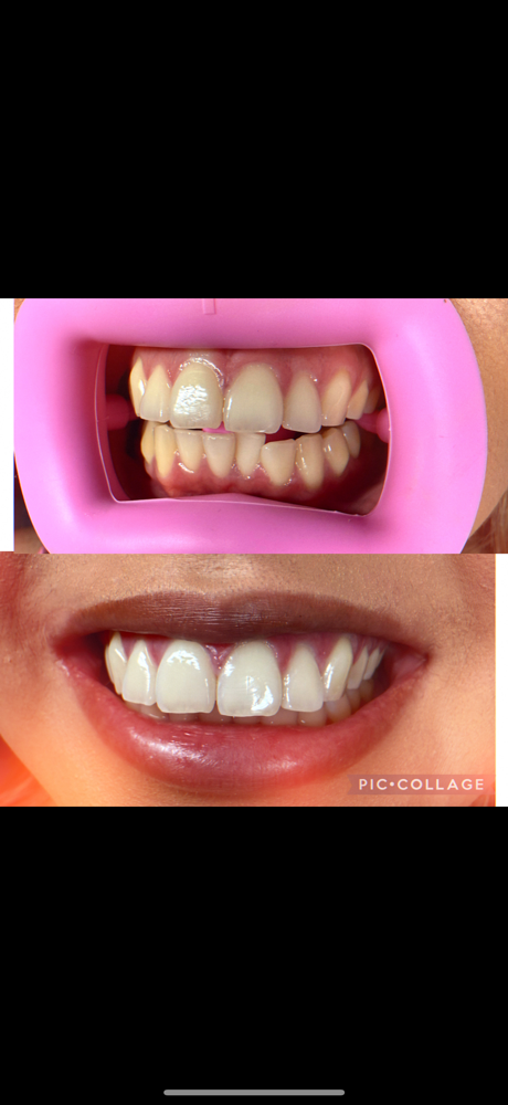 LED 60 Minute Whitening Session