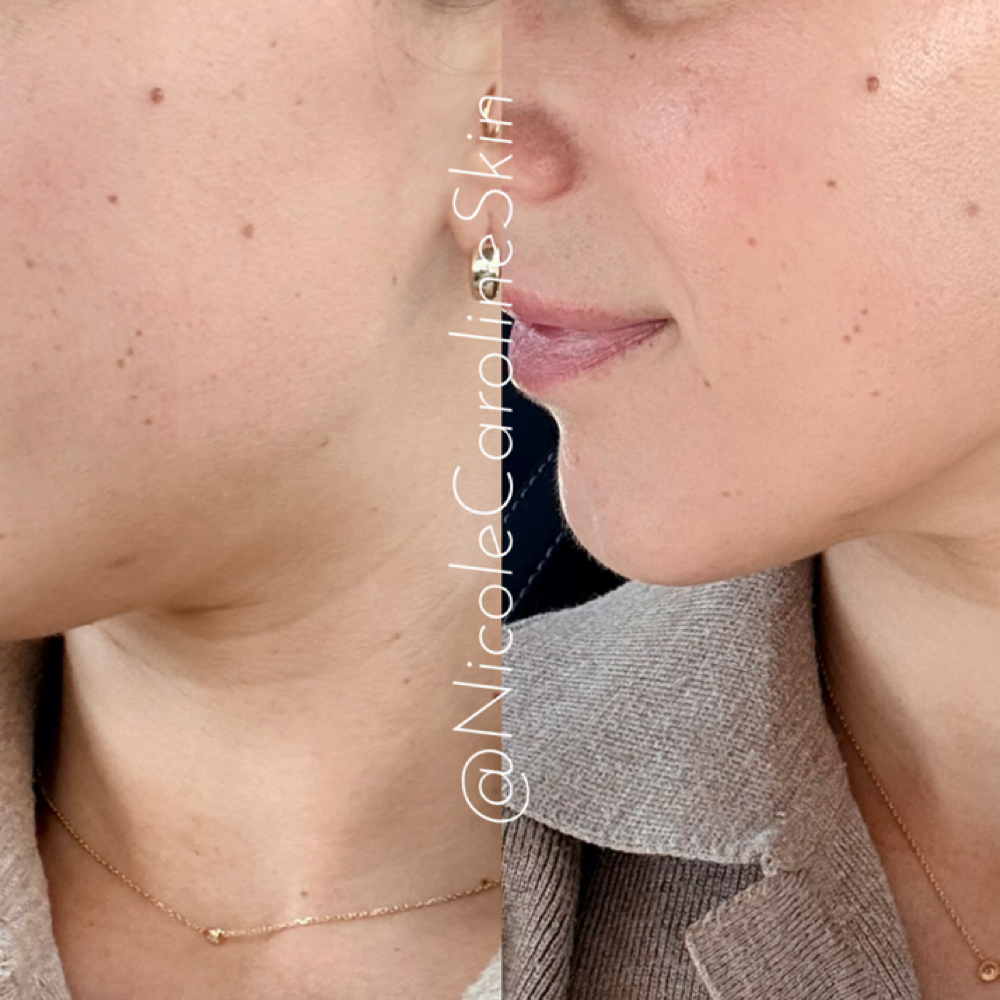 Lymphatic Drainage Facial at Nicole Caroline Skin in Greenwich, CT