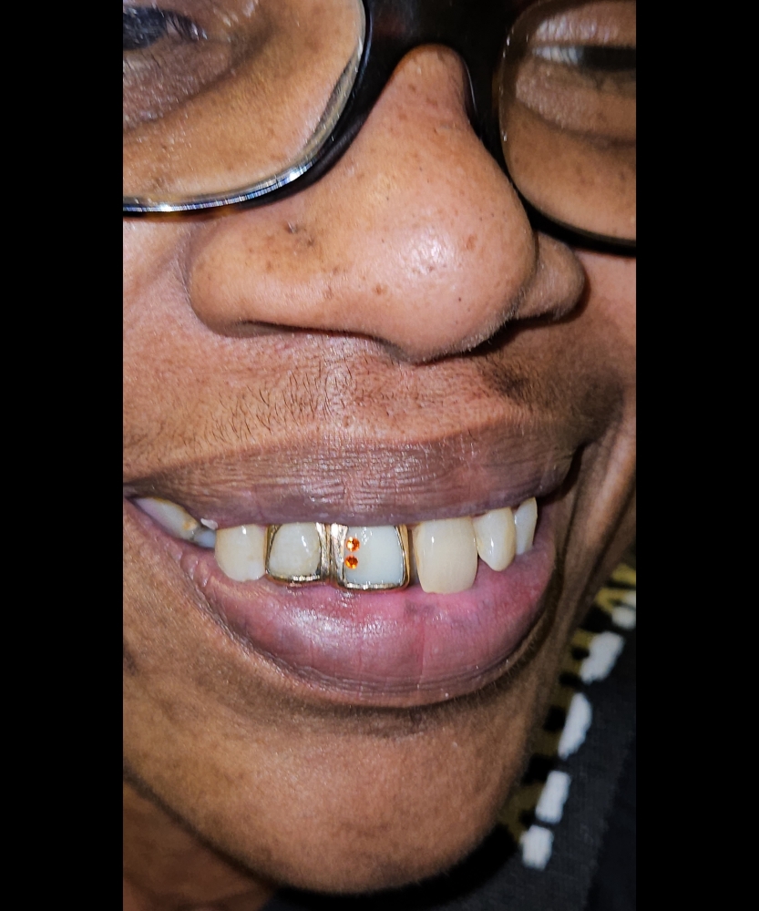 Gap Closure