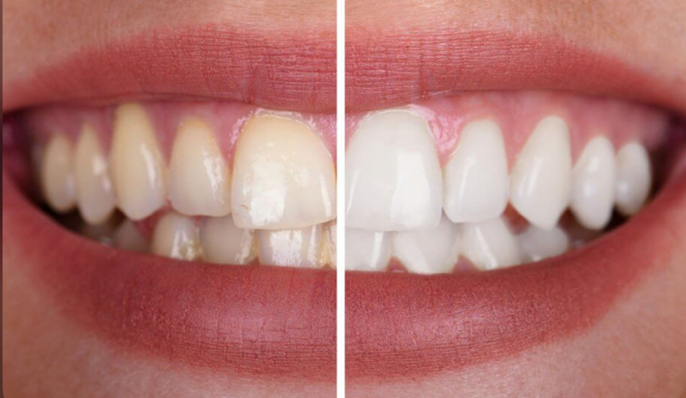Level 1 Whitening