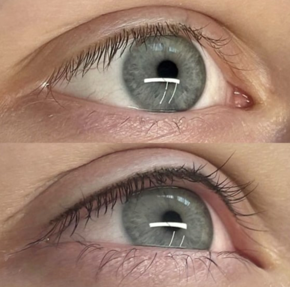 Eyelash Enhancement