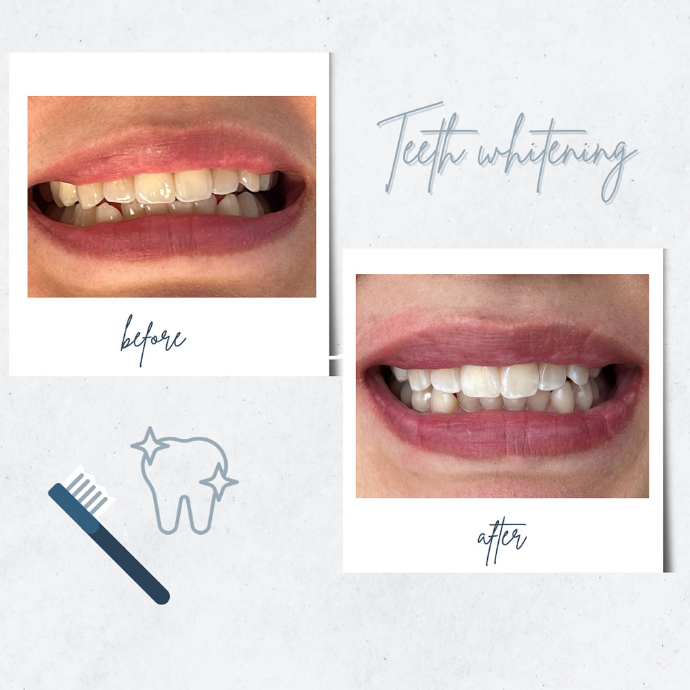 Teeth Whitening WED.ONLY